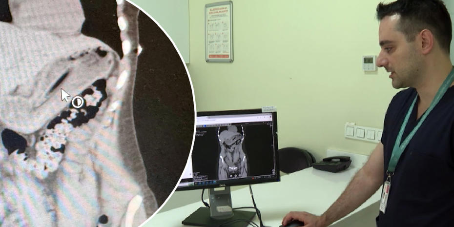 Zayıflama Çabası İçinde Diş Fırçası Yuttu, Sağlık Tehlikesi Atlatıldı