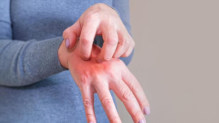 Artan vakalar temas tarafından iletilir, yoğun kaşıntı başlar