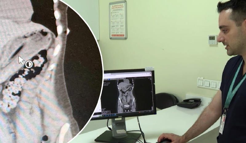 Zayıflama Çabası İçinde Diş Fırçası Yuttu, Sağlık Tehlikesi Atlatıldı